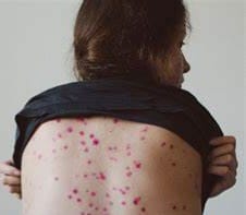 معلومات عن جدري القردة ويكيبيديا